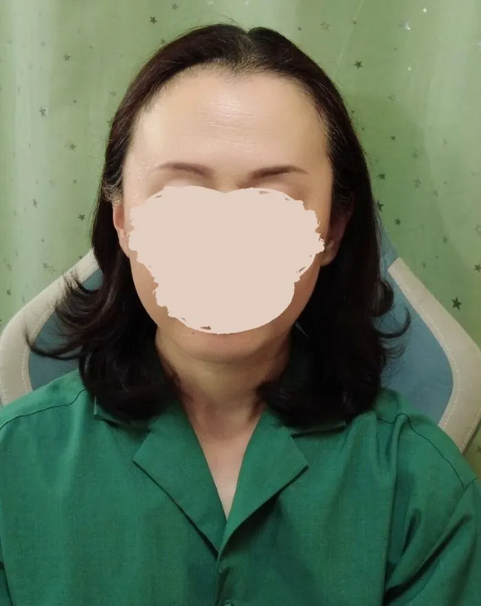 ウィッグ装着前の正面から見た頭部の状態（薄毛の様子）
