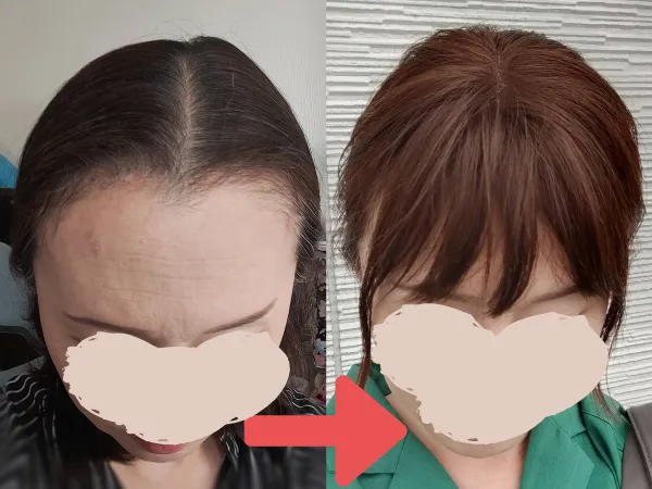 ナチュレトップヘアピース装着イメージ